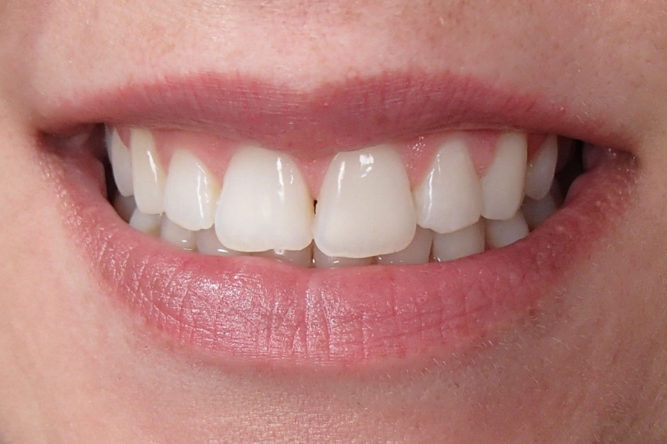 Crest 3D Whitestrips Luxe