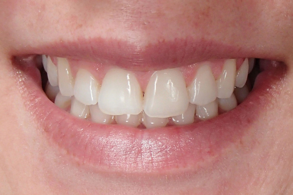 Crest 3D Whitestrips Luxe