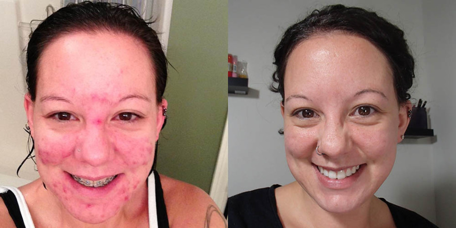 Skincare-Addiction Before & After