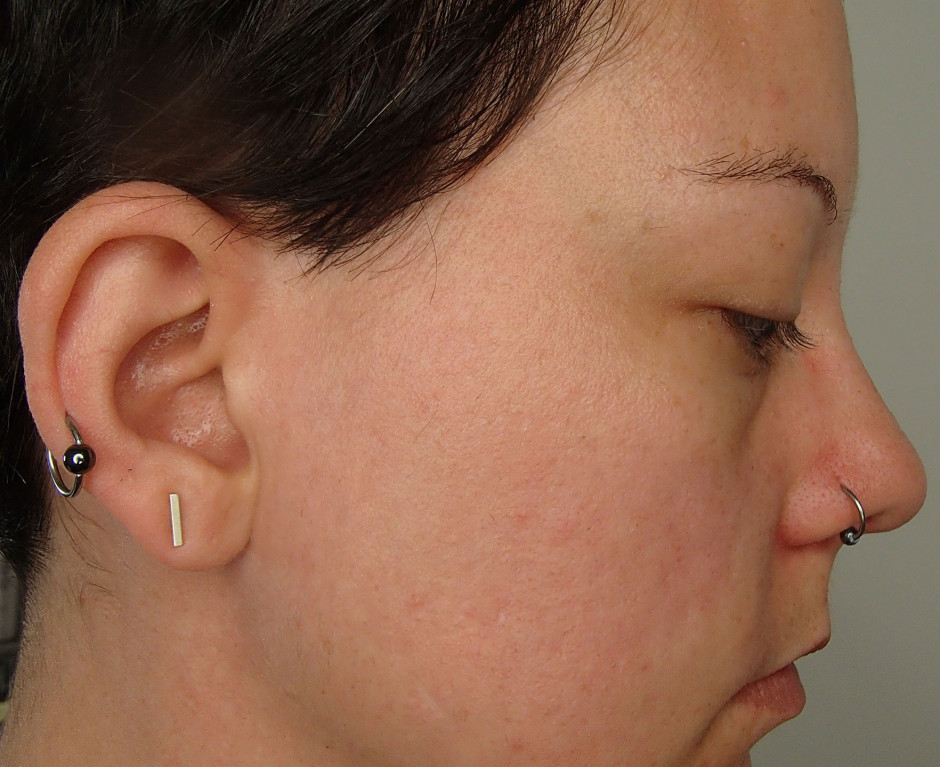 ORG MIneral Peel - after