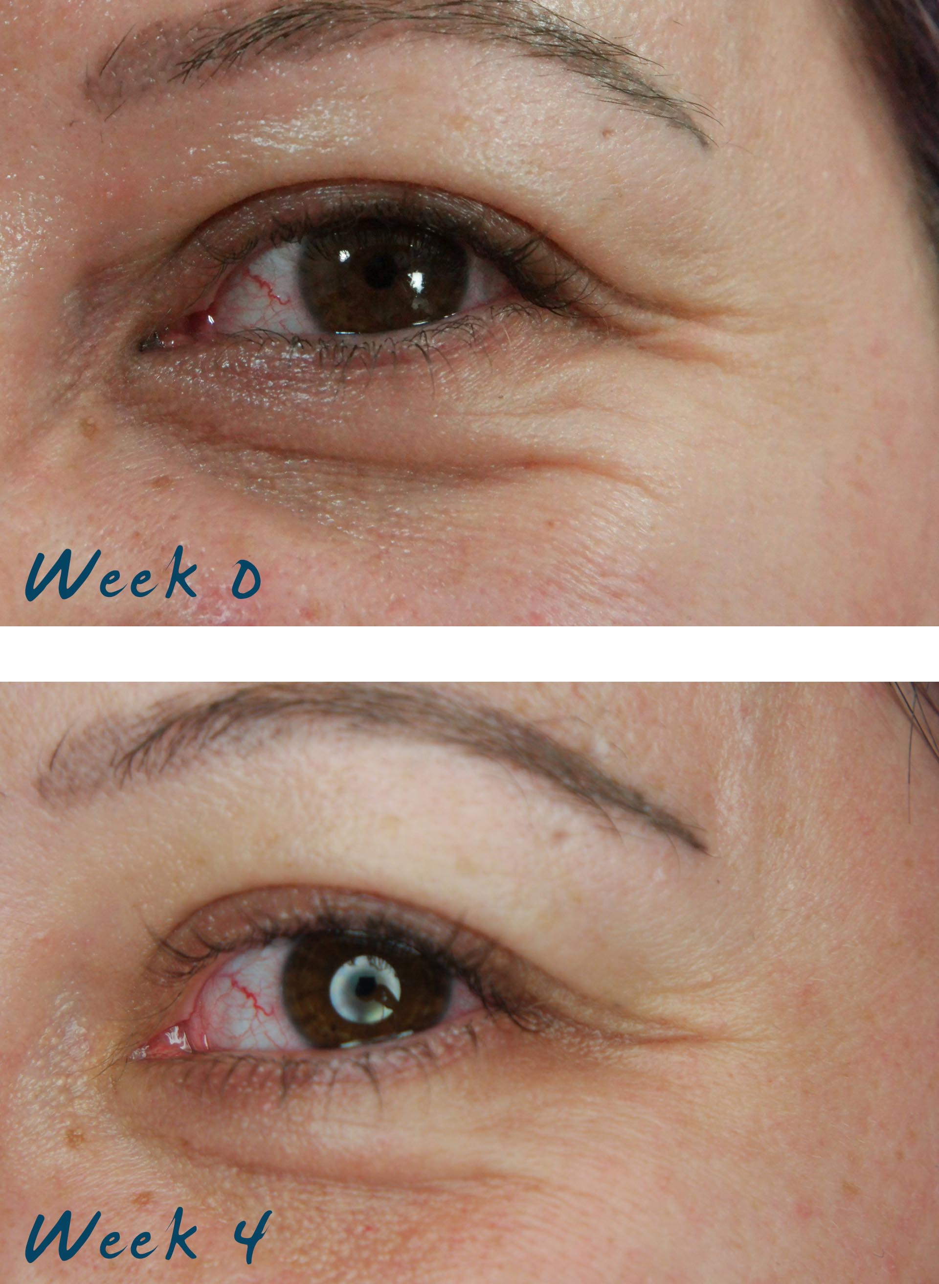 Tria Eye Wrinkle Correcting Laser Review Part 1 Lipstick Latitude