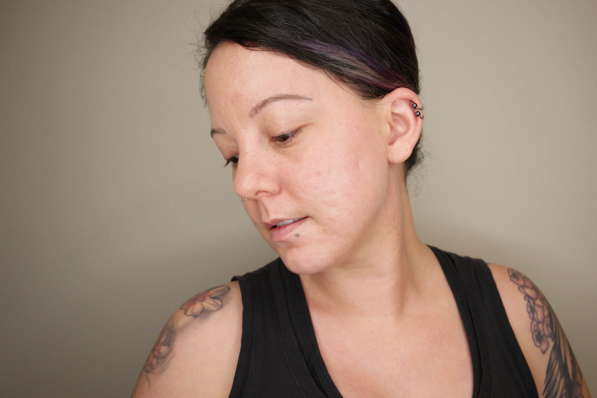 Retinoid update: how I got rid of acne discoloration